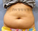 liposuction