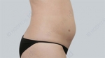 liposuction