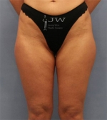 liposuction