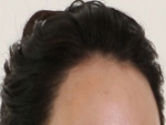 hairline