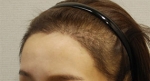 hairline