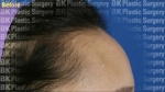 hairline