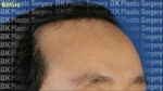 hairline