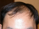 hairline