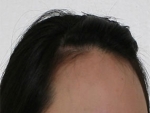 hairline