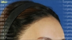 hairline