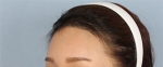 hairline