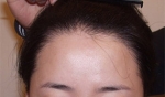 hairline