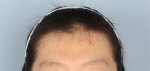 hairline