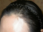 hairline