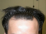 hairline