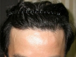 hairline