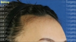 hairline