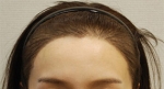 hairline