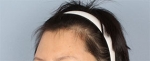 hairline