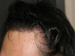 hairline