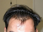 hairline