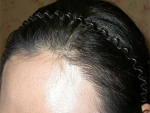 hairline