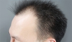 hairline