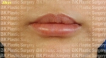 lip