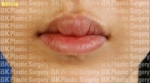 lip