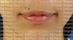 lip