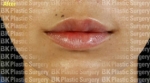 lip