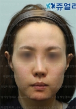 Rhinoplasty