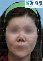 Rhinoplasty