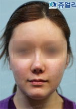 Rhinoplasty