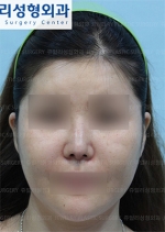 Rhinoplasty