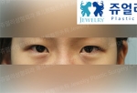 eye surgery