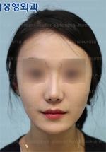 Rhinoplasty