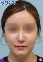 Rhinoplasty