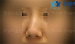 Rhinoplasty