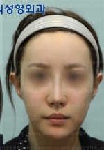 Rhinoplasty