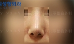 Rhinoplasty