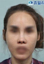 facial contouring