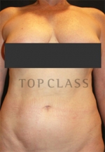 liposuction