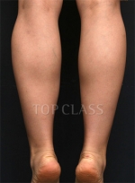 liposuction