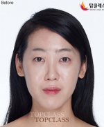 facial contouring