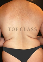 liposuction