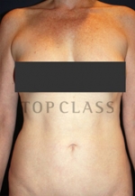 liposuction