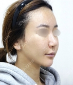 facial contouring