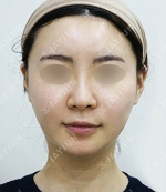 facial contouring