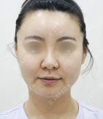 facial contouring