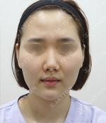 facial contouring