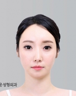 Rhinoplasty