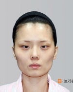 Rhinoplasty