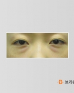 eye surgery